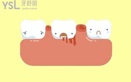 牙齒一吸就出血是什么原因？
