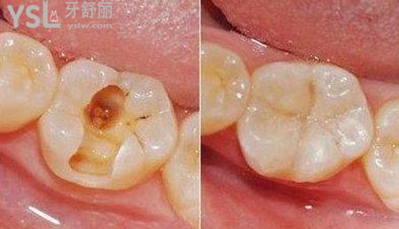補牙一般可以維持多久?