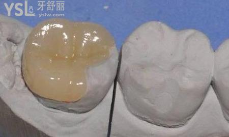 正規(guī)醫(yī)院補牙洞的價格是多少錢呢?