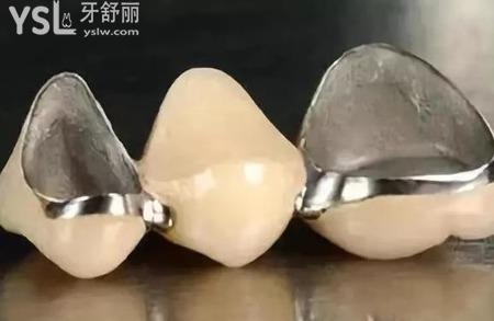 烤瓷牙是怎么安裝的？