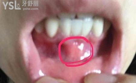 牙根發(fā)炎腫得非常好的我該怎么辦呢？