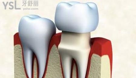 做個(gè)牙冠需要多少錢？