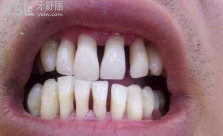 牙齦萎縮之后還能嗎？要怎么做？