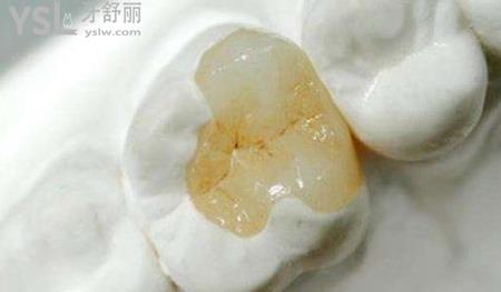 補牙的話一般牙科醫(yī)院多少錢一顆?