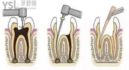 牙齒打樁要多少錢(qián)？