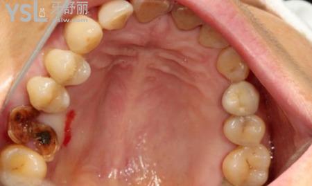 牙窩里白色物體是什么？