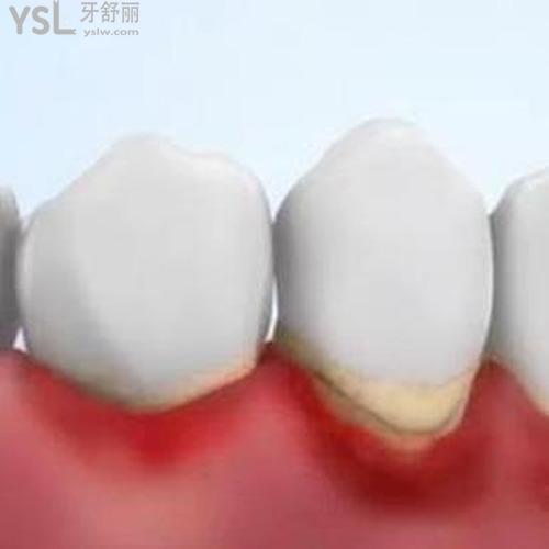 重度牙周炎有哪些癥狀？