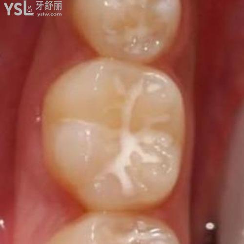 窩溝封閉后多久不能吃東西？