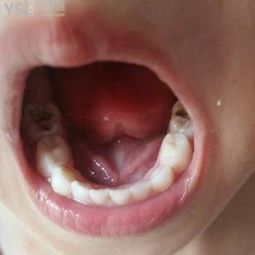 治療蛀牙的方法和步驟有什么注意的？