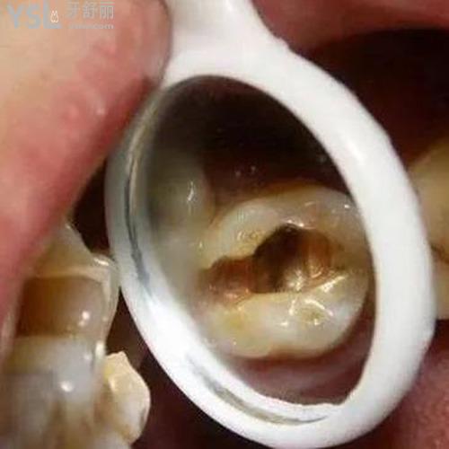 牙神經(jīng)抽掉了為什么還會(huì)疼？