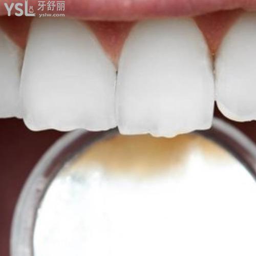 門牙可以補(bǔ)嗎掉了一點(diǎn)？