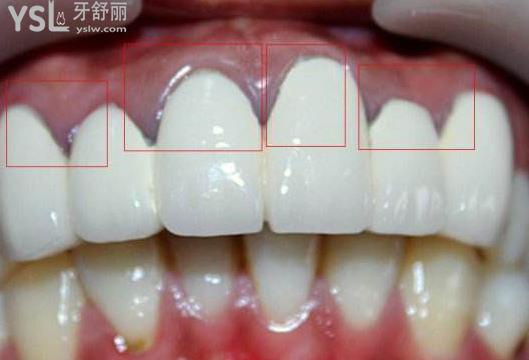 笑起來露牙床怎么辦？