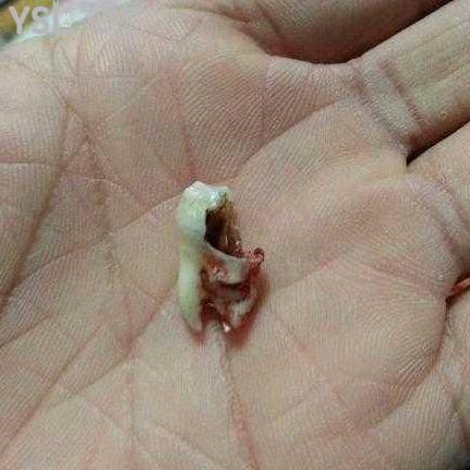 智齒蛀牙了補(bǔ)好還是拔掉好？