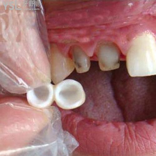 陶瓷牙套和鋼牙套哪個(gè)好？