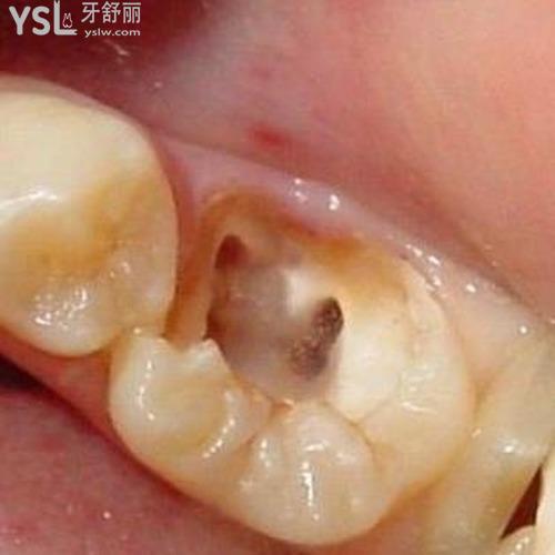 牙齒殺神經(jīng)后怎么還疼？會(huì)疼幾天？