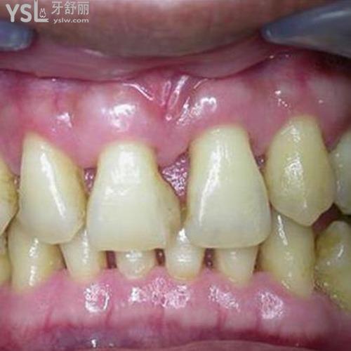 牙根發(fā)黑是什么原因？