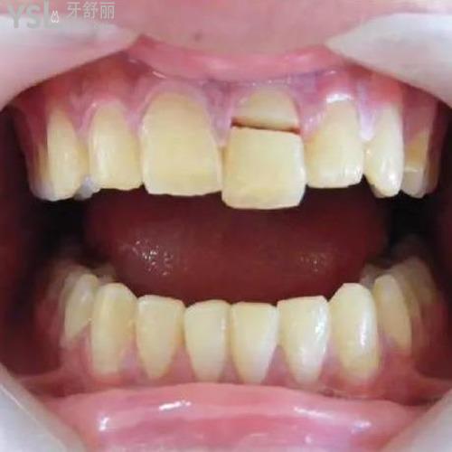 牙齒掉了一塊怎么處理？
