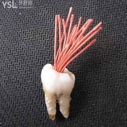 牙疼根管治療是什么意思？