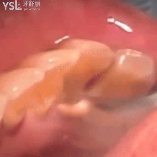 怎么能去除牙結(jié)石？