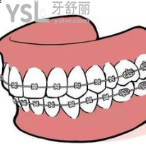 20歲的年輕人做牙套要做什么的？求解答