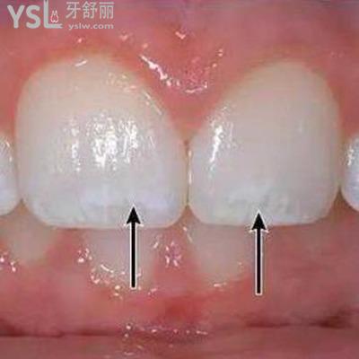 牙齒脫礦怎么治療？