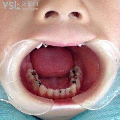 治療兒童蛀牙要多少錢？