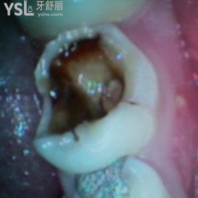牙齒神經(jīng)壞死了怎么辦？牙神經(jīng)壞死的癥狀是什么？