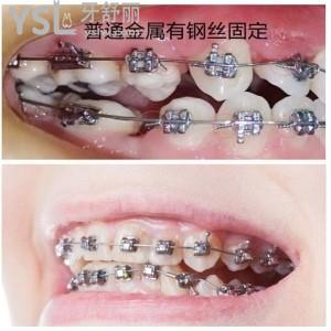帶牙套期間牙酸是代表牙齒一直在移動(dòng)嗎？