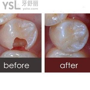 玻璃水門汀是什么材料 補牙好不好？