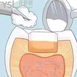 剛補好的牙就掉了一塊怎么辦？