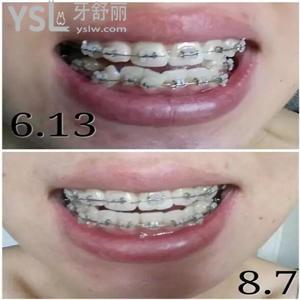 為什么成人不能矯正牙齒？