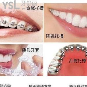 金屬自鎖牙套三萬元貴不貴？