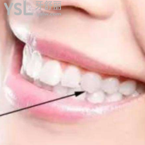 自然標準的牙齒咬合側(cè)面是什么樣的？