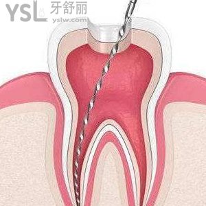 做根管治療要去幾次牙科醫(yī)院？