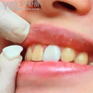 美加超薄瓷貼面