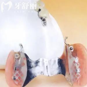 精密附著義齒