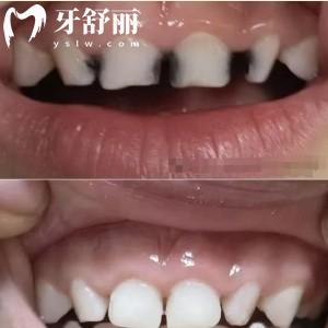 兒童預(yù)成冠