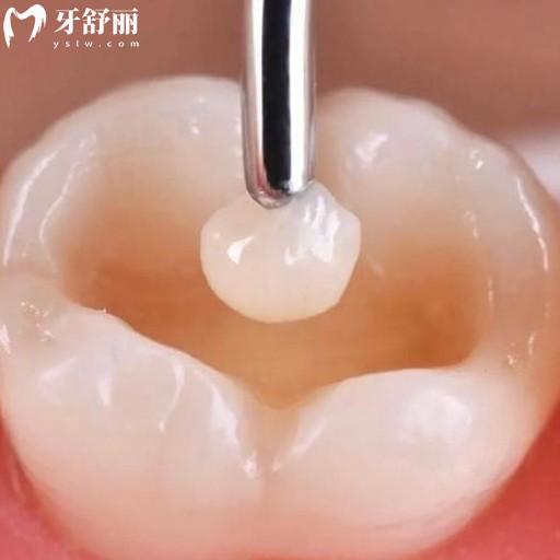 有蛀牙了，有沒(méi)有知道第一次補(bǔ)牙流程和注意事項(xiàng)的？