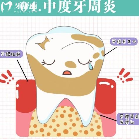 牙周炎一輩子都治不好嗎？怎么樣才能徹底根除？