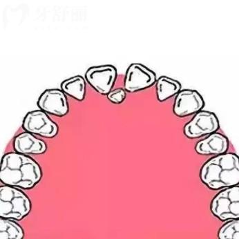 成人多生牙拔除有什么風險嗎？