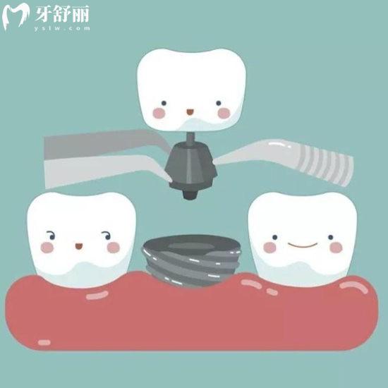 為什么網(wǎng)上這么多種植牙失敗案例，還敢種牙嗎？