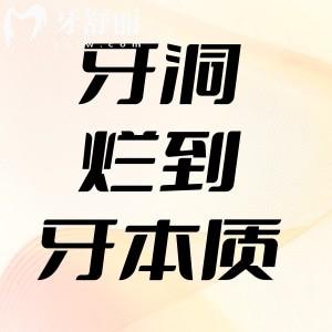 牙洞爛到牙本質(zhì)會(huì)怎么樣？