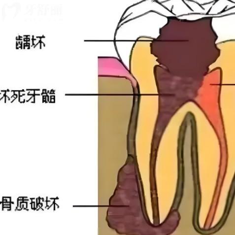 急性牙髓炎和慢性牙髓炎有什么區(qū)別？