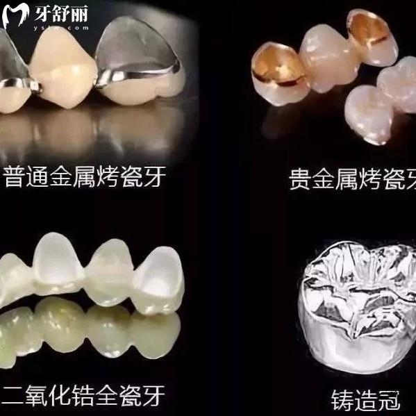 鑲一顆牙能維持多久？