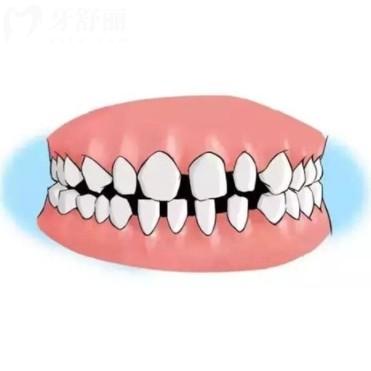 孩子牙縫大是什么原因？需要現(xiàn)在干預(yù)矯正嗎？