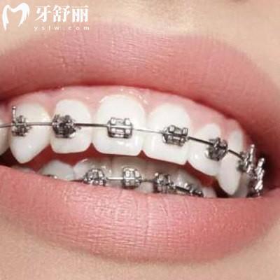 告知曲靖正規(guī)口腔醫(yī)院收費標準是怎樣的，價目表更新包含舌側隱形矯正等項目