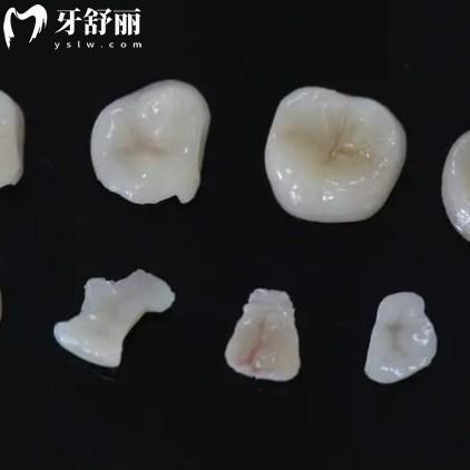 嵌體有哪些材質(zhì)？哪種比較好？