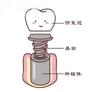 上海牙科種牙價格表公開!/治療/種植牙費用及醫(yī)生名單分享