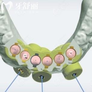 數(shù)字化種植牙和傳統(tǒng)種植牙哪個(gè)貴？