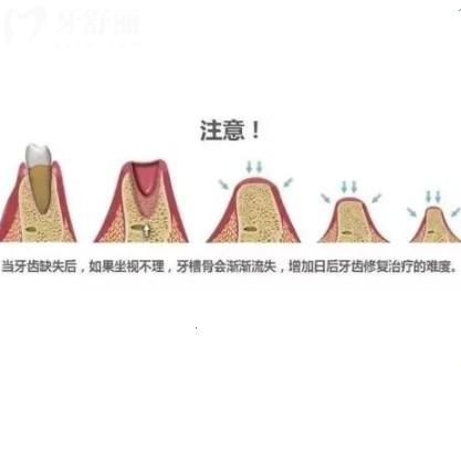 牙槽骨**手術(shù)